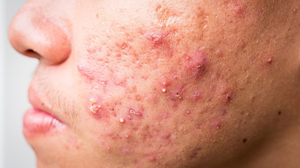 Acne face Singapore