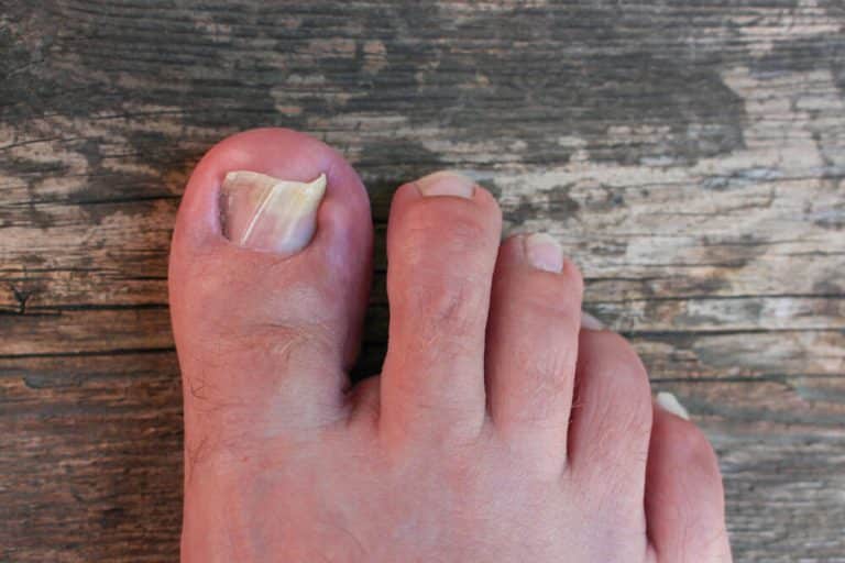Ingrown Toenails: Signs, Causes, Treatment & Prevention - Lumine ...