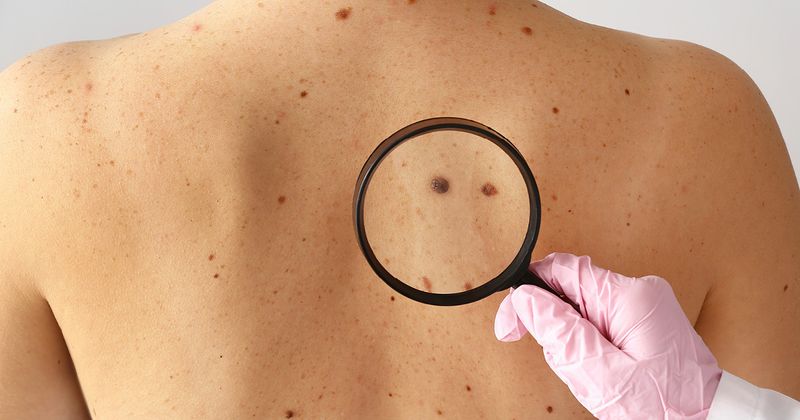 Mole self-examination
