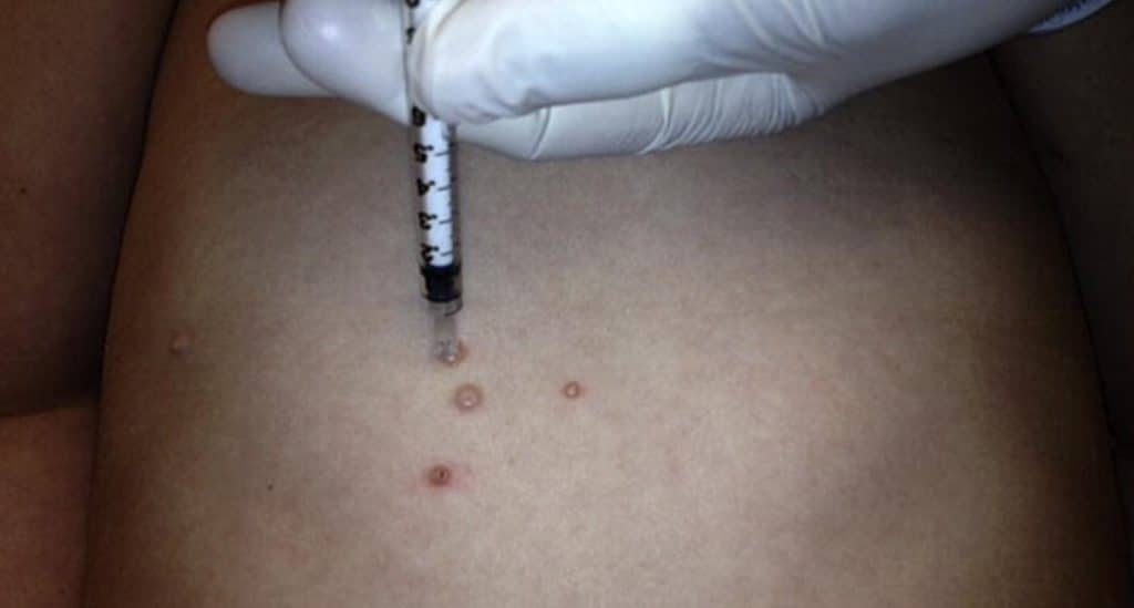 Cantharidin Application for Moluscum