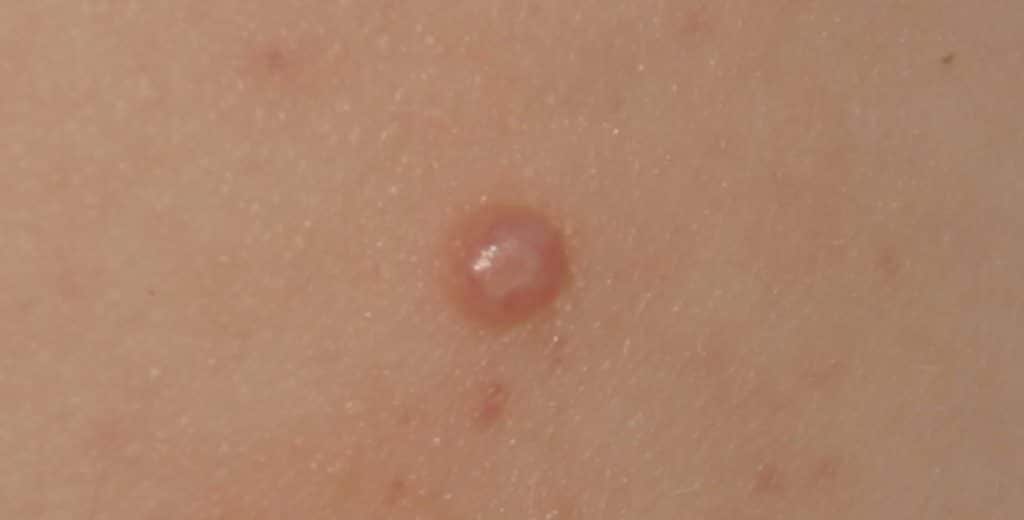 Molluscum Contagiosum