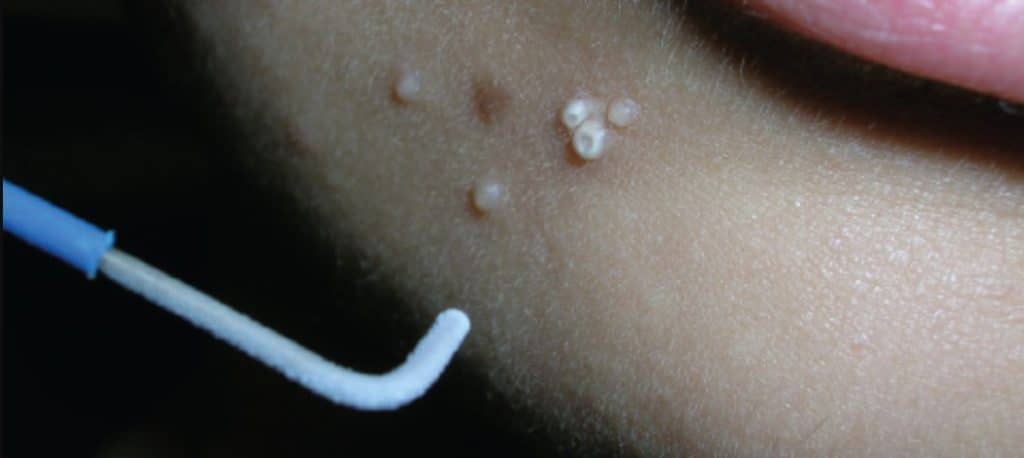 Cryotherapy for Molluscum