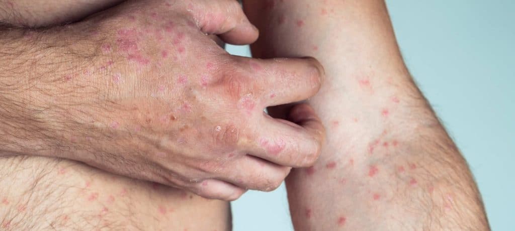 Papular Eczema