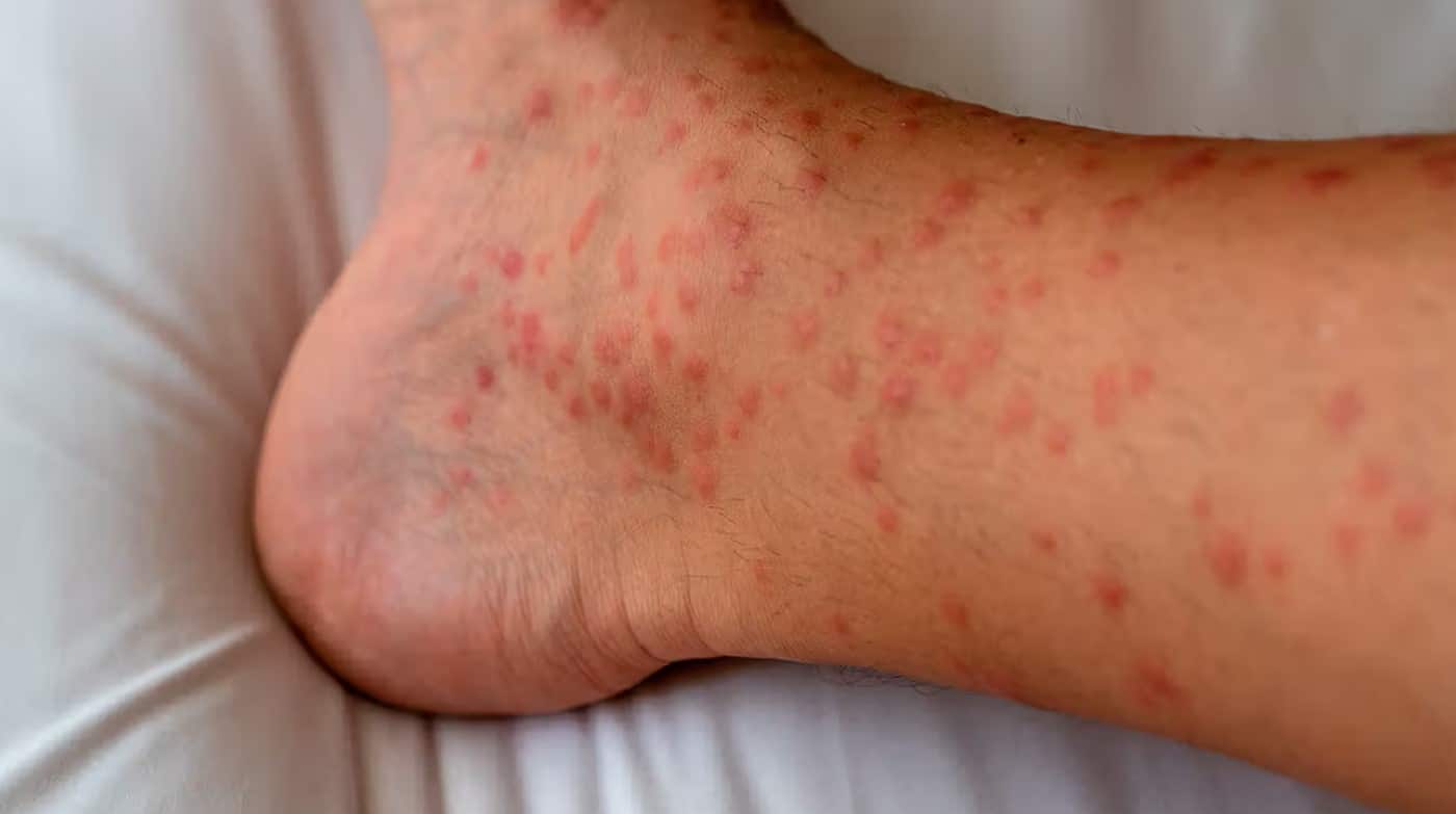 Papular Eczema