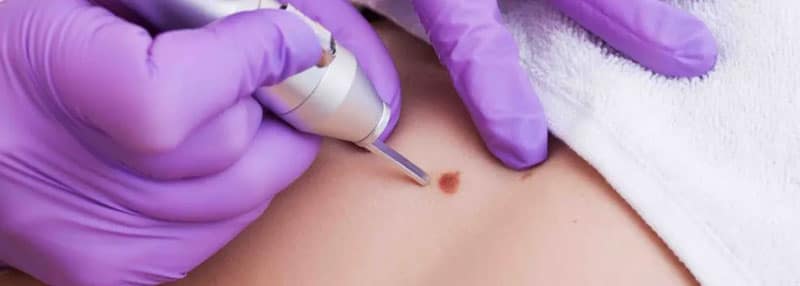 Molluscum Extraction