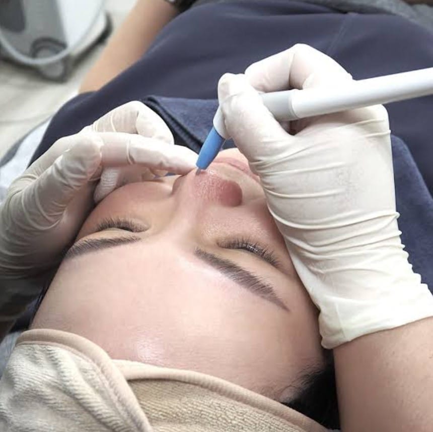 Agnes RF Treatment