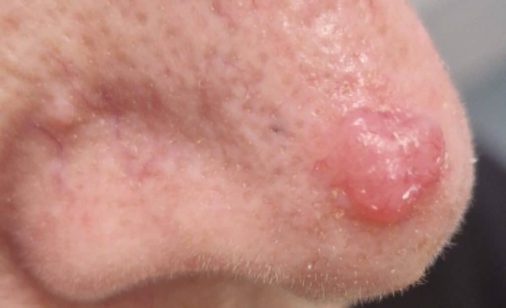 Amelanotic melanoma