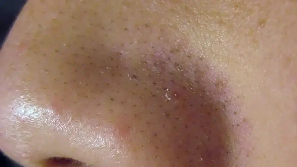 Blackheads and Enlarged Sebaceous Glands