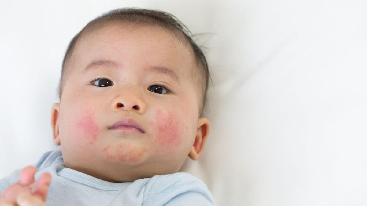 Child Atopic Dermatitis