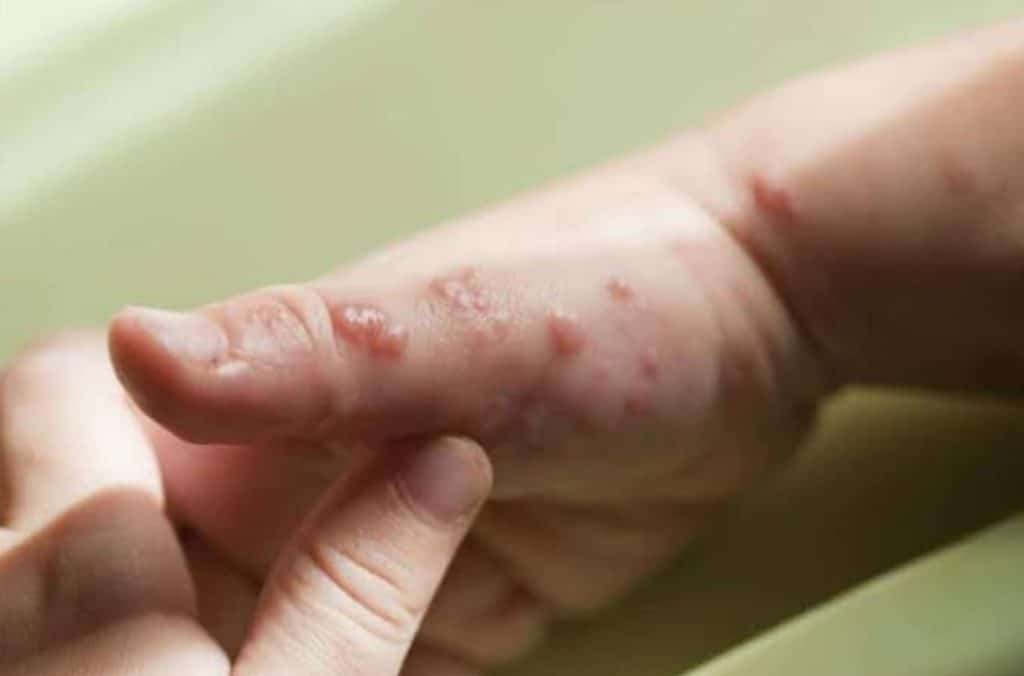 Child Fungal and Bacterial Skin Infection