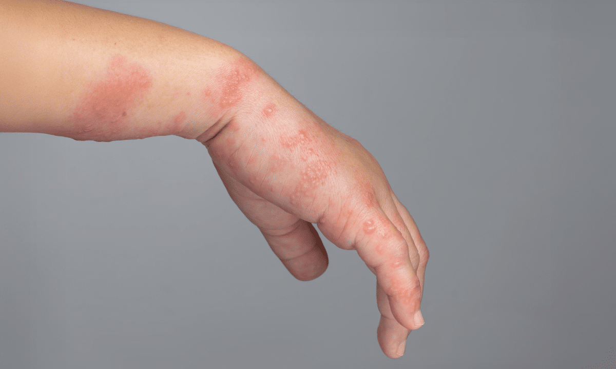 Child Fungal and Bacterial Skin Infection