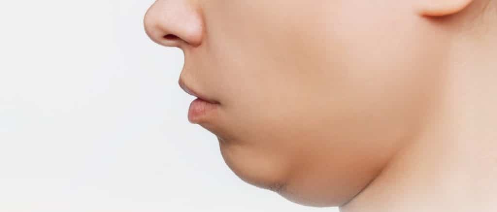 Double Chin