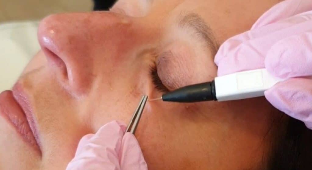 Facial Electrosurgery