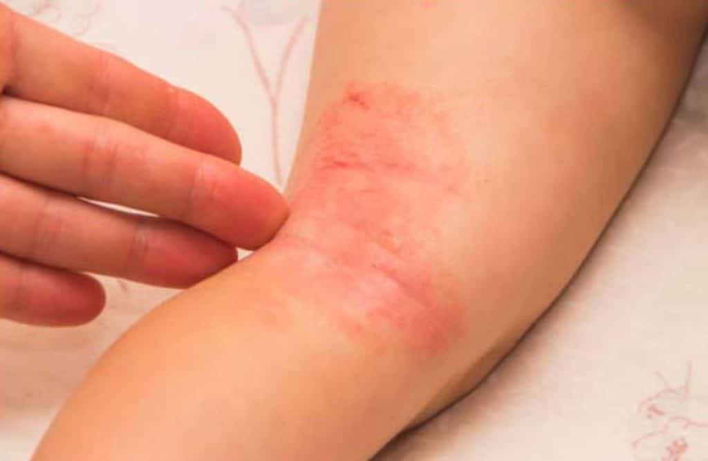 Fungal Skin Infection