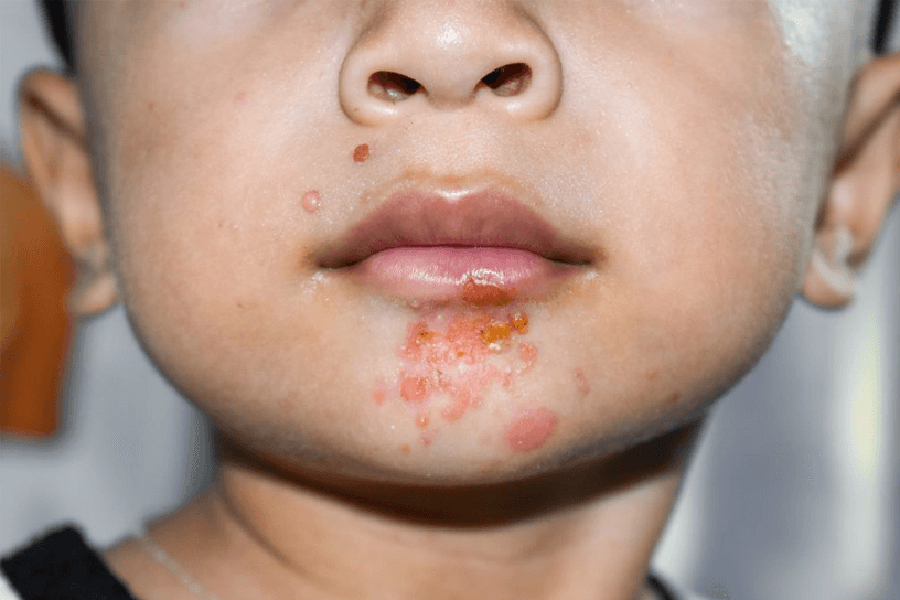 Impetigo