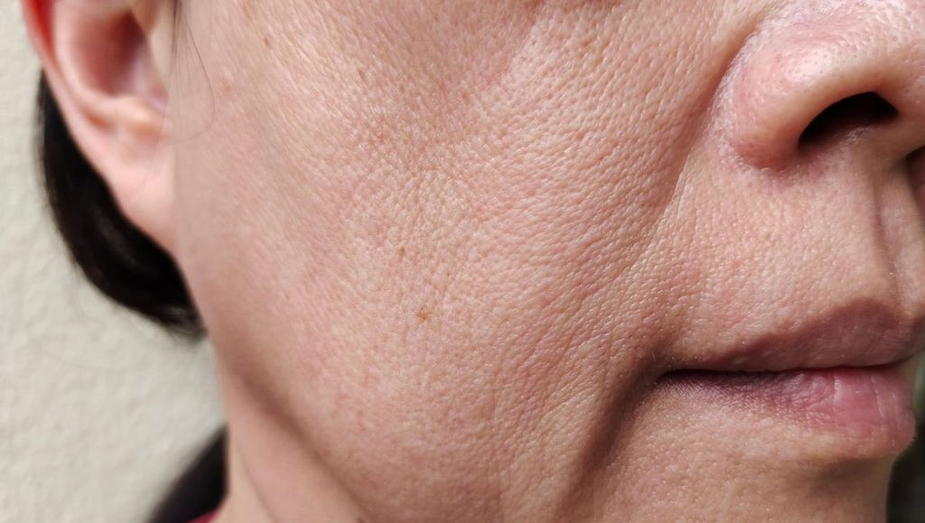 Jowls and Localised Facial Fullness