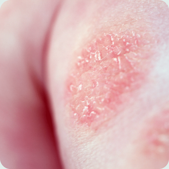 Paediatric Eczema