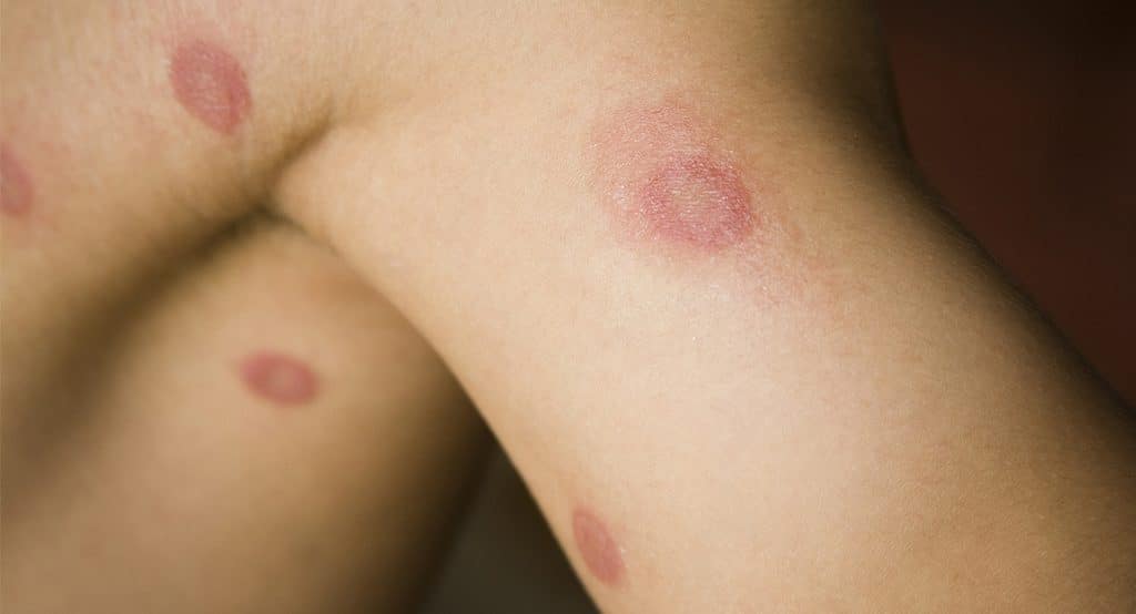 Ringworm Treatment for Children