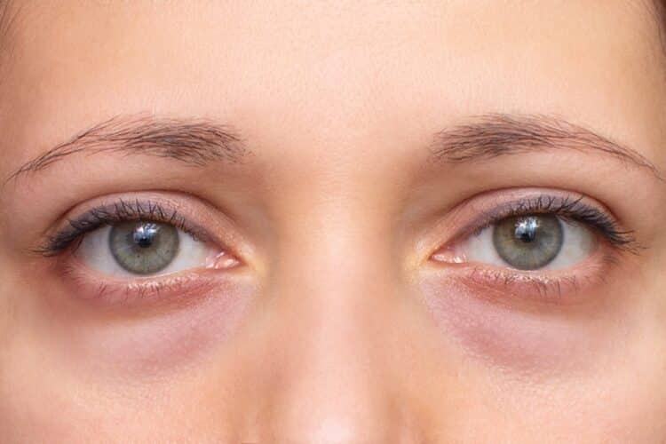Under-Eye Bags