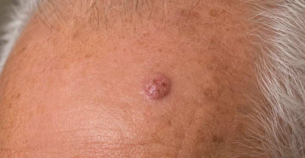 Squamous Cell Carcinoma