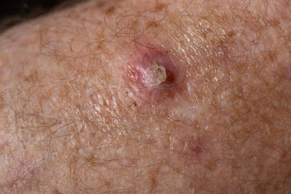 Squamous Cell Carcinoma
