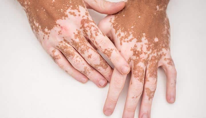 Vitiligo