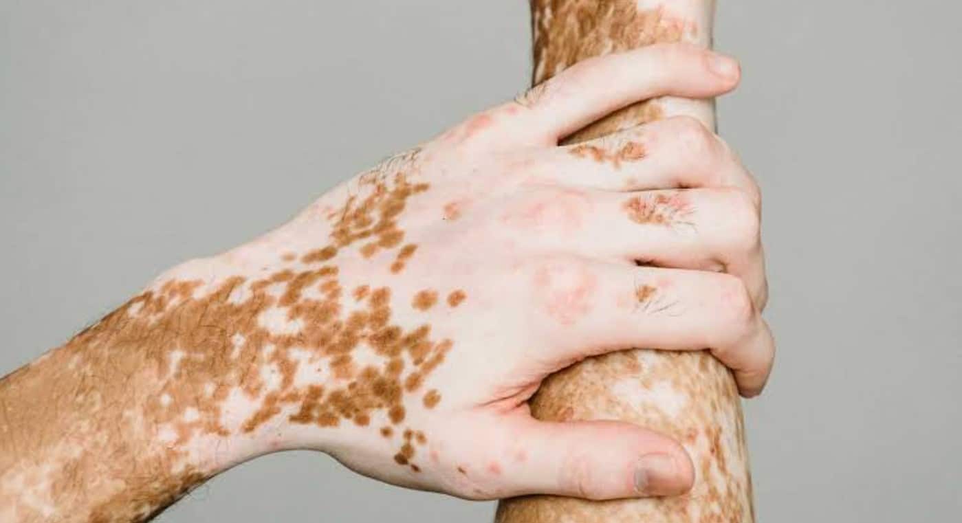 Vitiligo