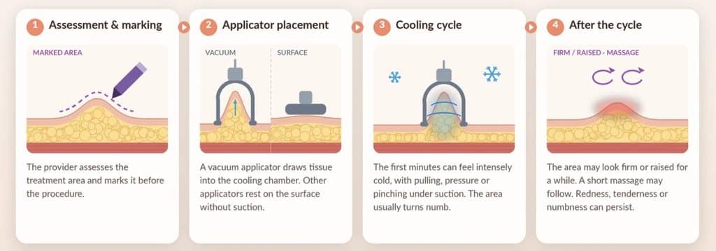 Four-step diagram of a fat-cooling treatment: marking the area, placing a vacuum or surface applicator, the cooling cycle, and the treated area afterwards, with a note on recovery